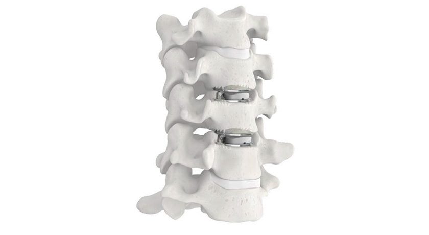 ZimVie Mobi-C Cervical Disc