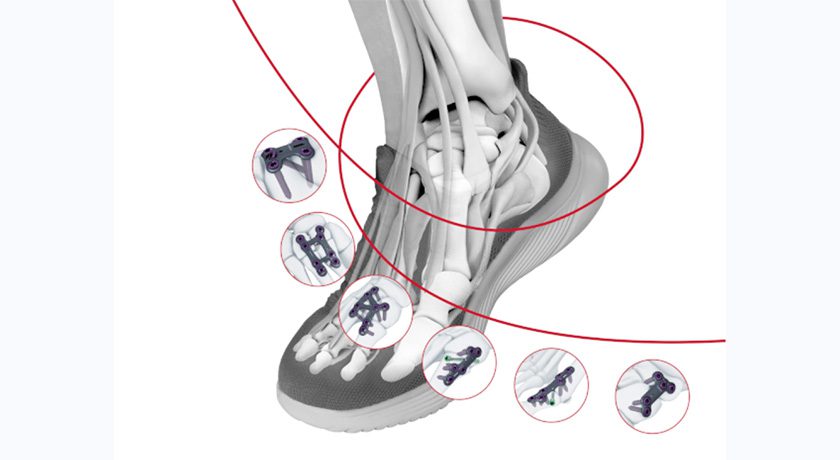 DePuy Synthes TriLEAP Lower Extremity Anatomic Plating