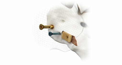 Vyrsa spinal technologies