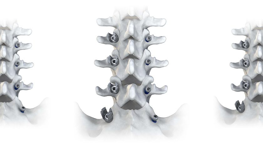 Accelus LineSider Modular Cortical System