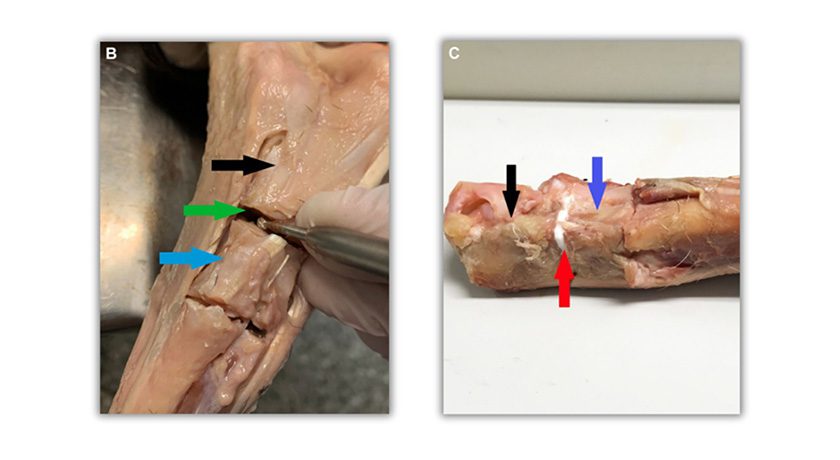 Biomimetic OsStic Bone Void Filler