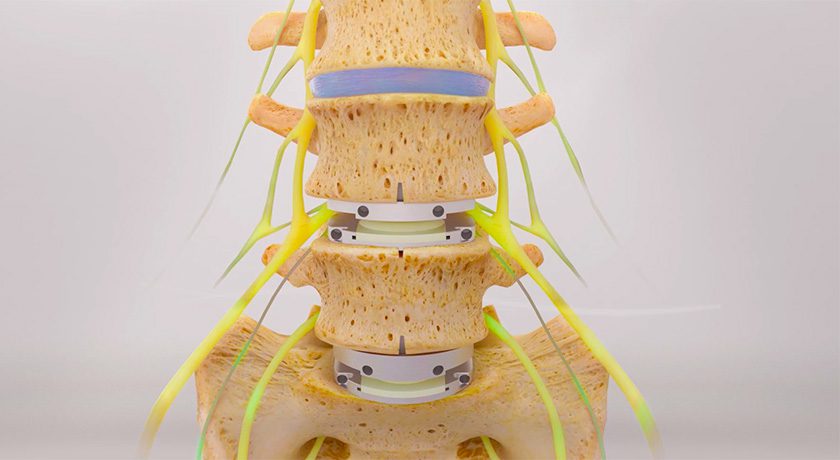 Centinel Spine prodisc-L Artificial Lumbar Disc