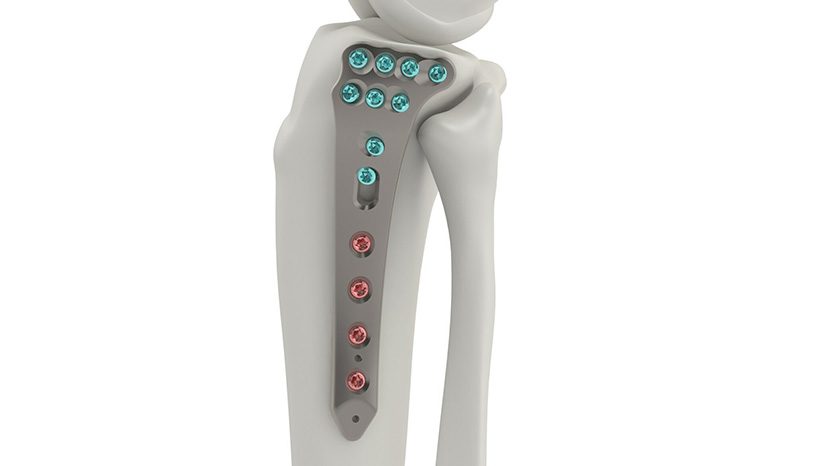 Tyber Medical Proximal Tibia Plating