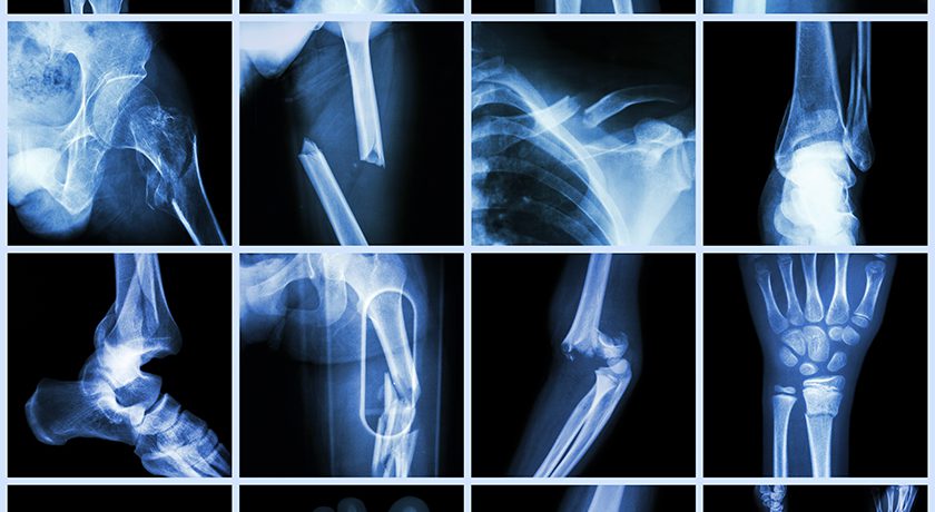 We highlight three companies that seek to capture a portion of the trauma market with novel approaches to fracture repair.