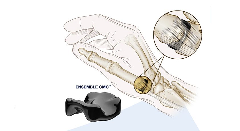 Ensemble Orthopedics CMC Joint Replacement