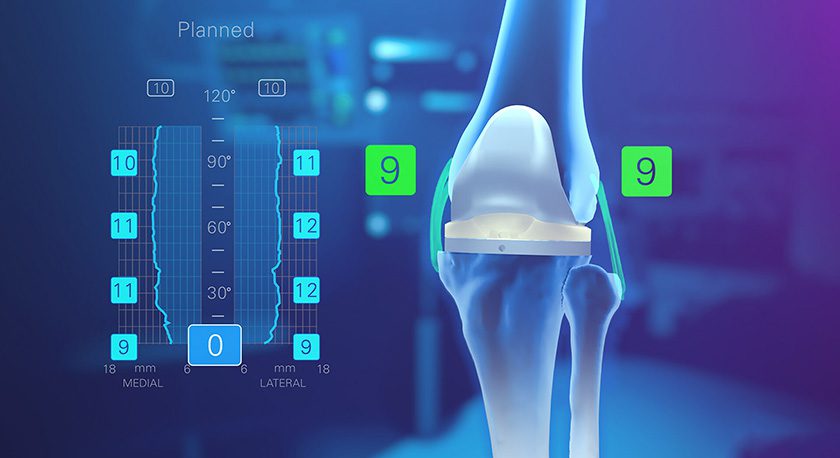 Exactech Newton Soft Tissue Balancing Technology