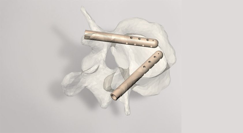 Hyprevention V-STRUT Vertebral Implant