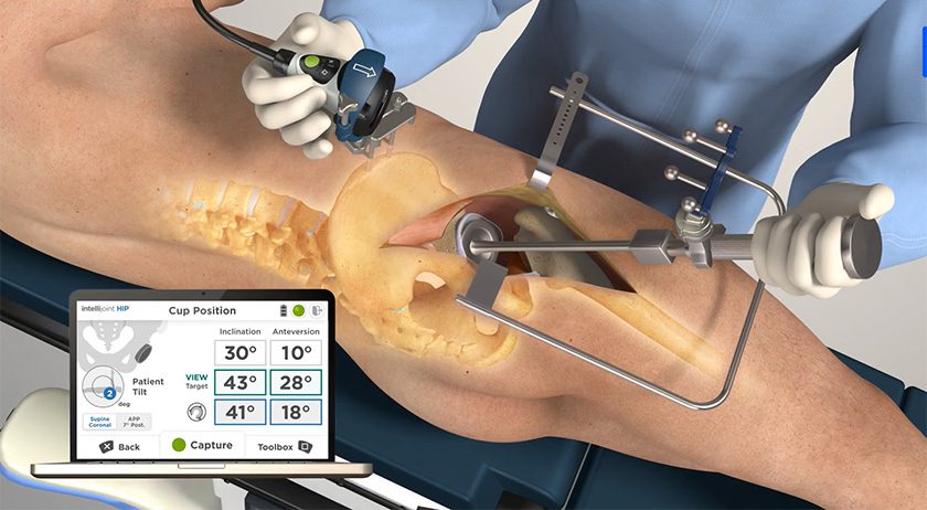 Intellijoint Surgical Intellijoint VIEW