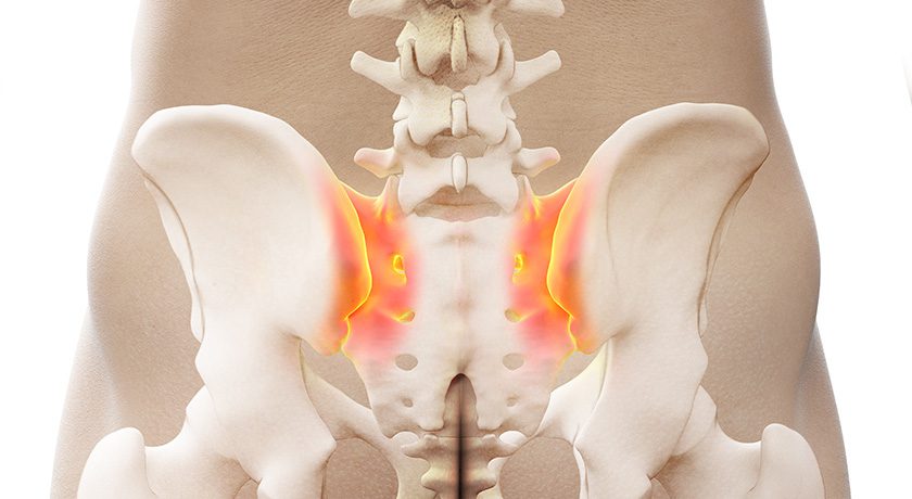 Inflamed Sacroiliac Joints