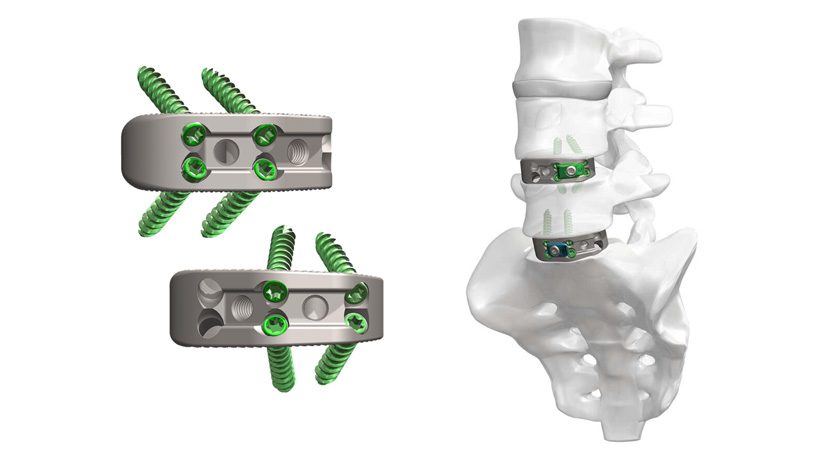 NovApproach Spine OneLIF