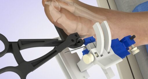 Voom Medical MIBS CoPilot