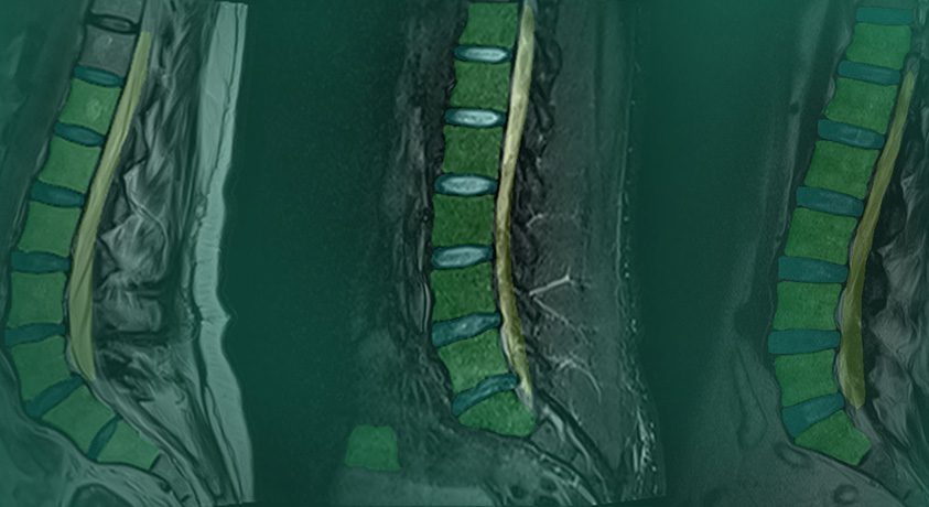 MSKai Spine Imaging Software Receives FDA 510(k)