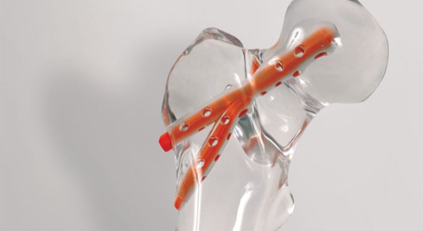 Hyprevention Y-Strut Hip Implant