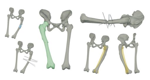 Insight Surgery raises $2.5m investment to scale FDA-cleared personalized orthopedic surgery across US