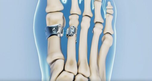HyperFlex Medical Bunion Repair