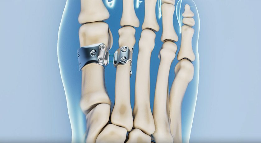 HyperFlex Medical Bunion Repair