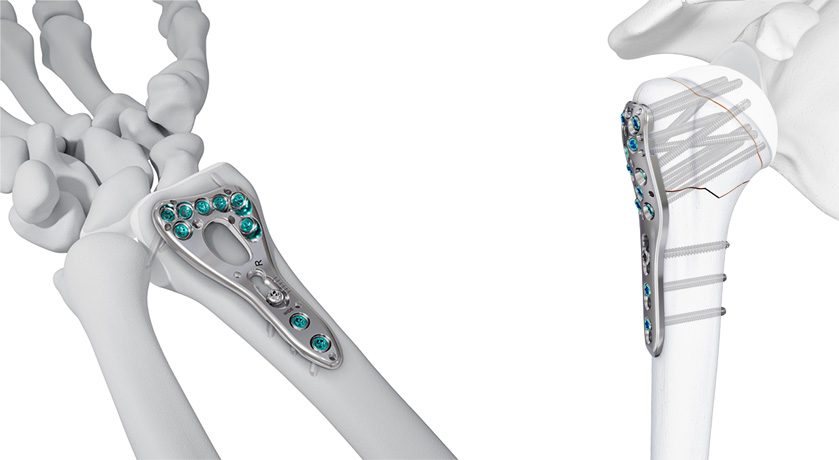 Johnson & Johnson VOLT Wrist and Proximal Humerus Plating Systems