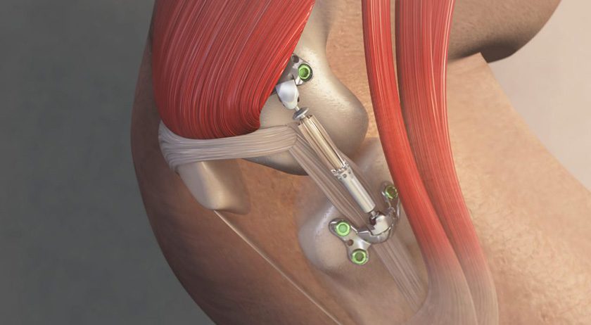 Moximed MISHA Knee System