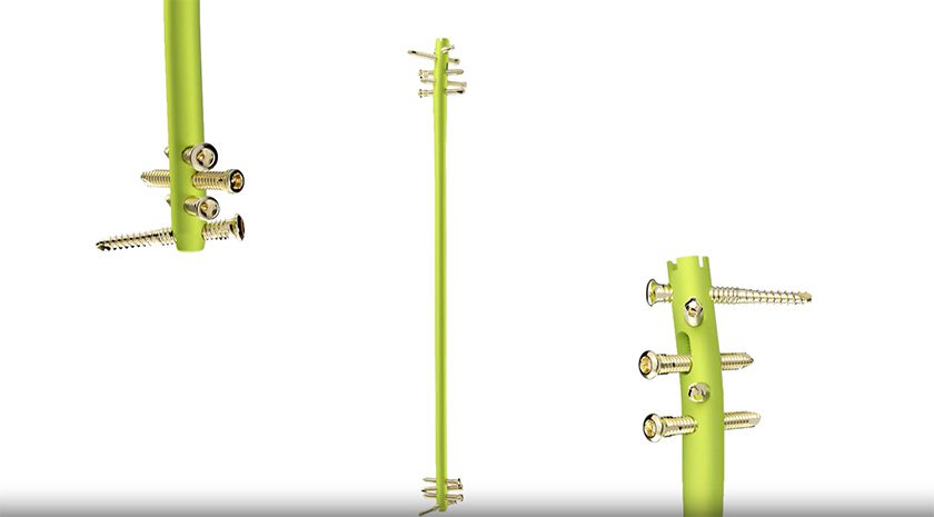 Smith+Nephew TRIGEN MAX Tibia Nailing System