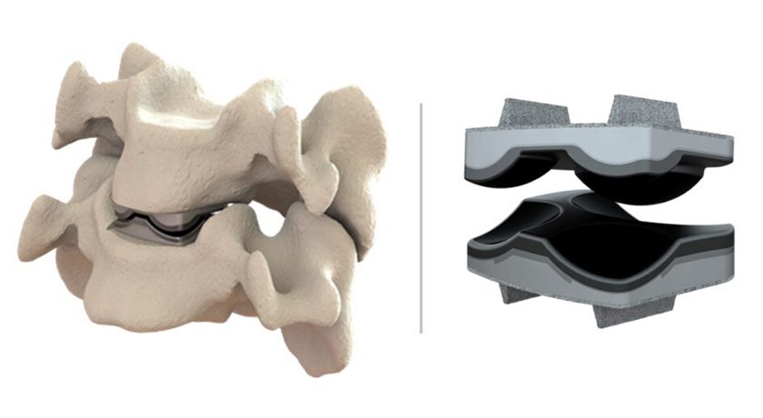 Dymicron Triadyme Cervical Disc