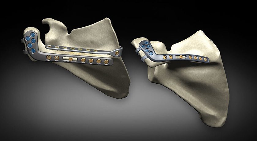 Exactech Scapula Reconstruction