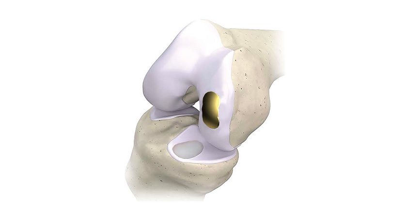 Overture OvertureTi Knee Resurfacing