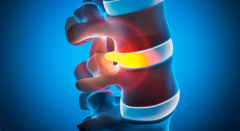 Vivex Biologics, Inc. Completes Subject Enrollment for its ASCEND Trial Evaluating VIA Disc NP