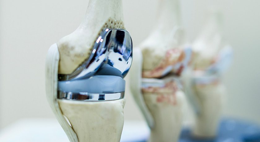 ForCast Orthopedics Reaches Initial Close of Series A Financing Round