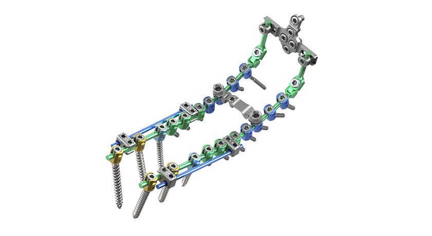 ulrich medical USA® Announces Full Market Launch of Cortium Universal OCT Spinal Fixation