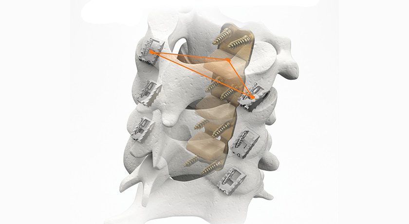 Providence Medical Technology CORUS Posterior Cervical Stabilization
