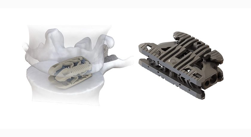Accelus Spine Devices Acquired by Highridge Medical