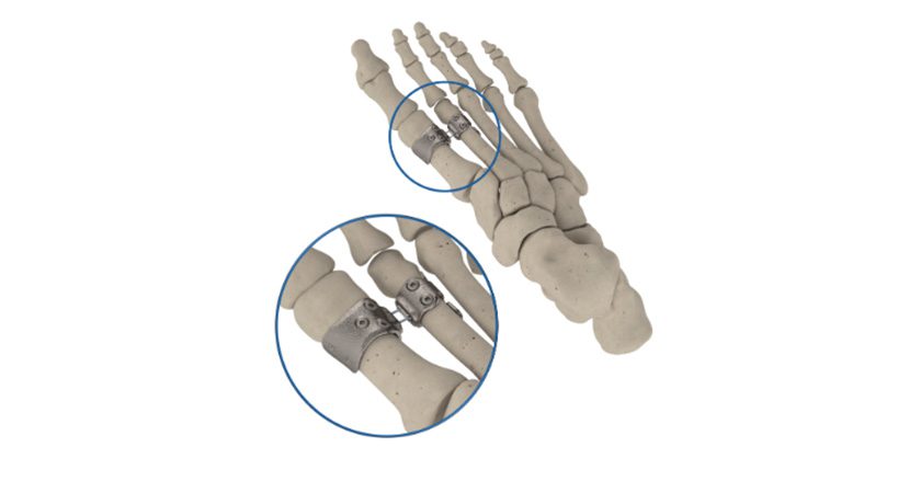 HyperFlex Medical Bunion Correction