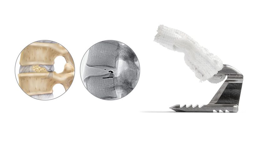 Intrinsic Therapeutics Barricaid® Annular Closure Device