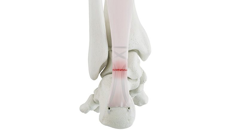Medline Industries Forcecord Achilles Repair