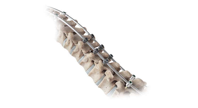 OrthoPediatrics VerteGlide Spinal Growth Guidance System
