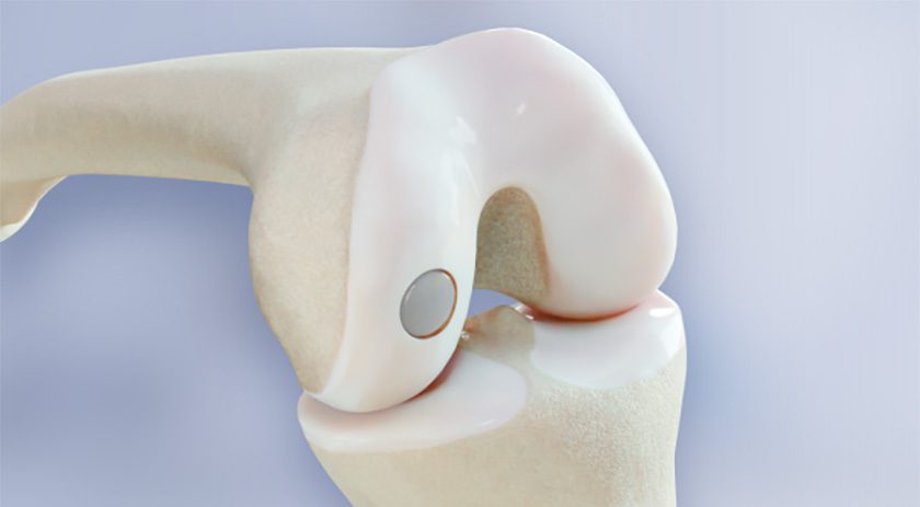 BioPoly Partial Resurfacing Knee
