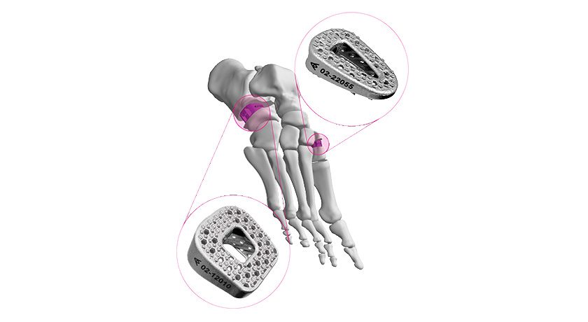 Auxano Medical ARKEO Wedge