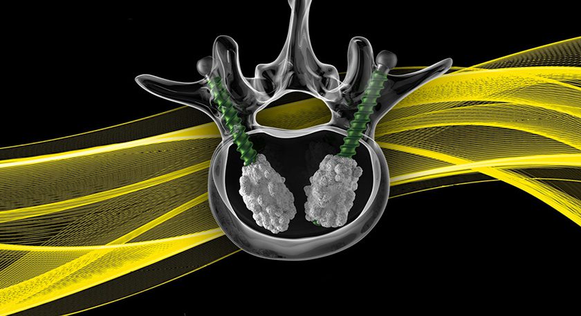 Biedermann Motch MOSS!MODULARITY Injection Screw