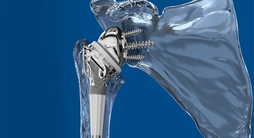 Catalyst OrthoScience Catalyst Fracture Shoulder