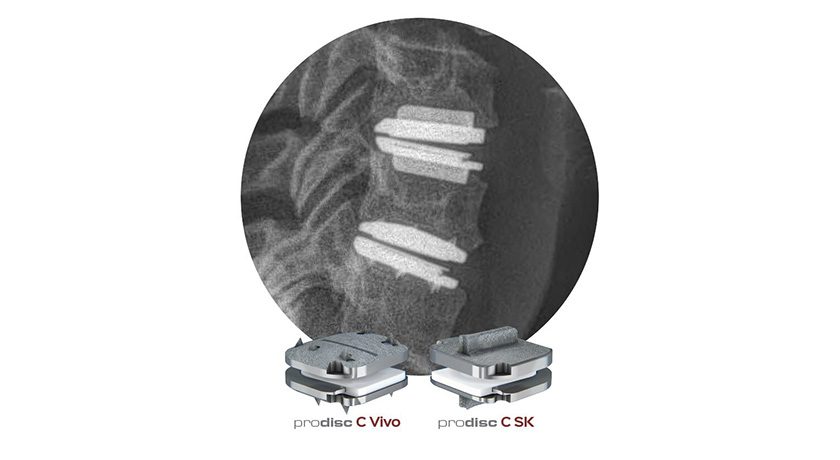 Centinel Spine prodisc C Vivo and prodisc C-SK