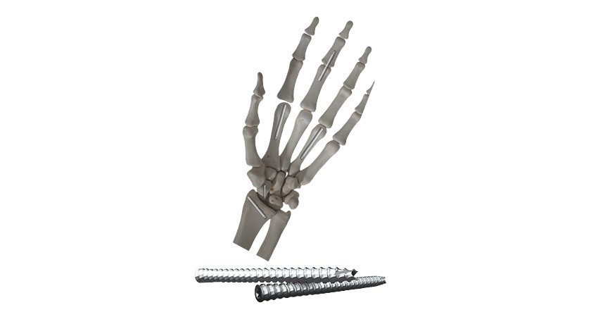 Diamond Orthopedic Faceted Screw