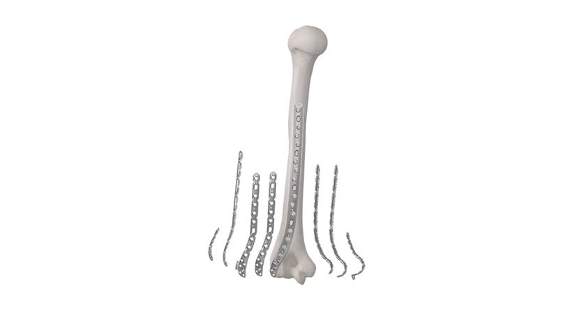 Globus Medical ANTHEM Elbow Fracture System