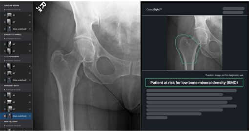 Naitive Technologies OsteoSight