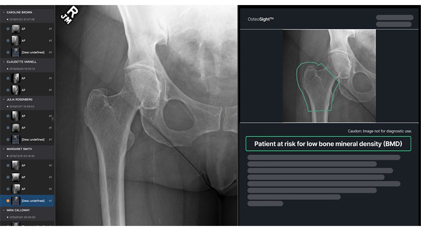 Naitive Technologies OsteoSight
