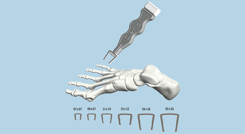 Spartan Medical Clench System