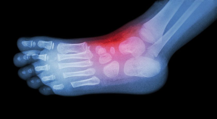 First Clinical Use of VersaCoat Flowable Hydrogel in Upper & Lower Extremities