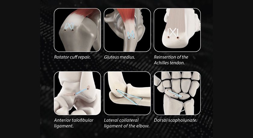 GMReis FASTLOCK Sports Medicine Devices