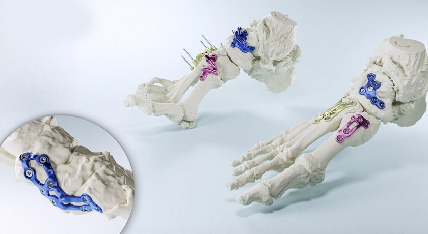 MedCAD AccuStride Fixation