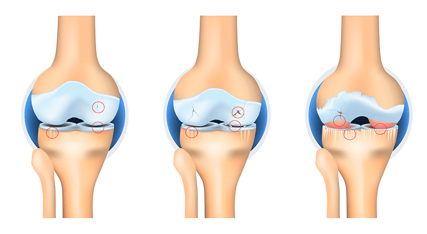 osteoarthritis cartilage defects