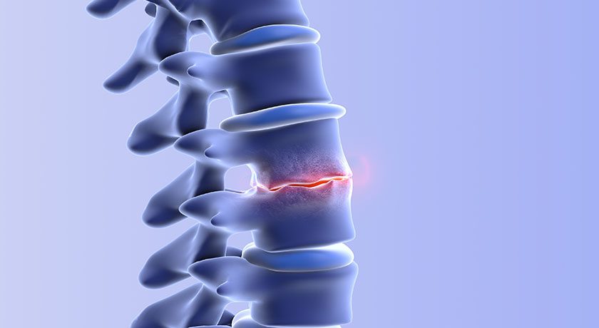 Spine degenerative disc disease